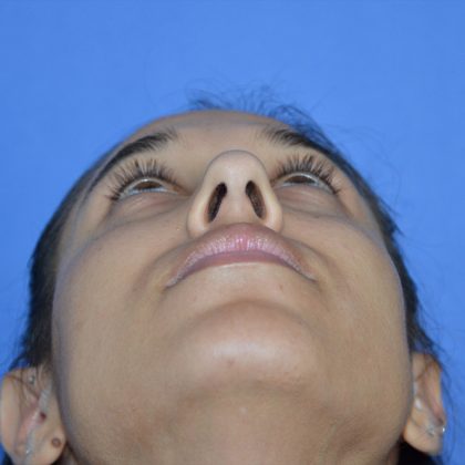 Rhinoplasty Before & After Patient #9995