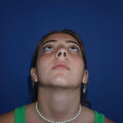Rhinoplasty Before & After Patient #9996