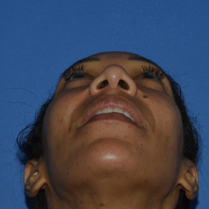 Regenelift™ Facelift Before & After Patient #9998
