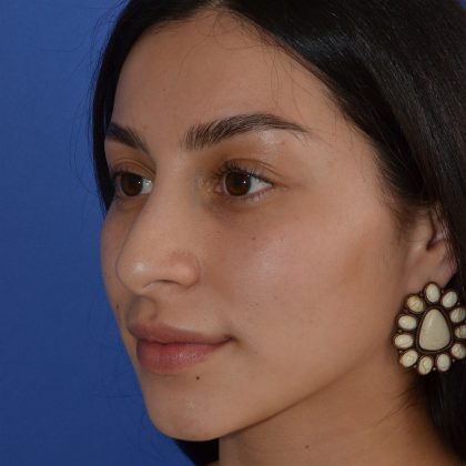 Rhinoplasty Before & After Patient #9999