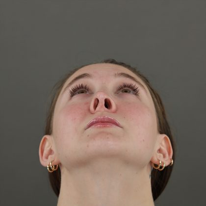 Rhinoplasty Before & After Patient #10000