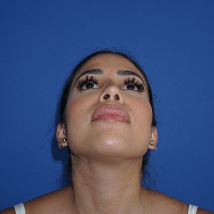 Browlift Before & After Patient #10001