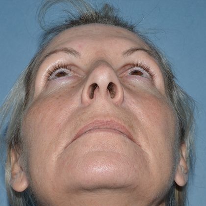 Regenelift™ Facelift Before & After Patient #9786