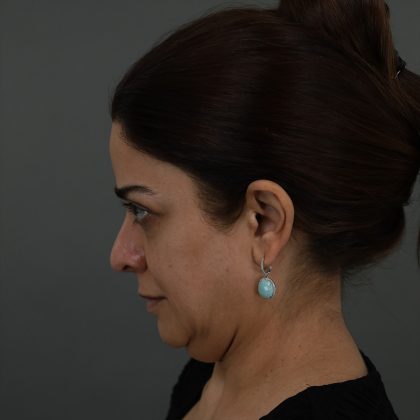 Regenelift™ Facelift Before & After Patient #9788