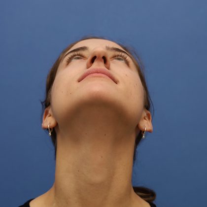 Rhinoplasty Before & After Patient #9790