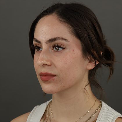 Rhinoplasty Before & After Patient #9783