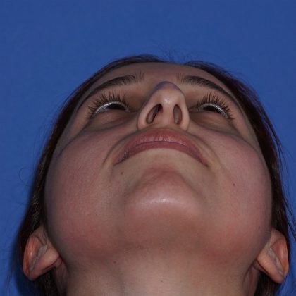 Rhinoplasty Before & After Patient #9791