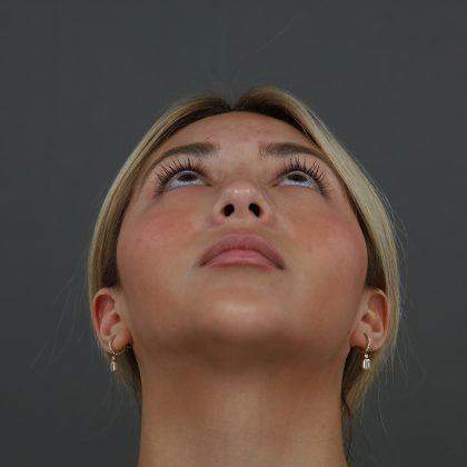 Rhinoplasty Before & After Patient #9987