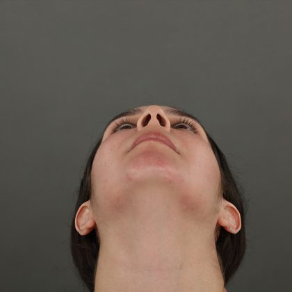Rhinoplasty Before & After Patient #9988