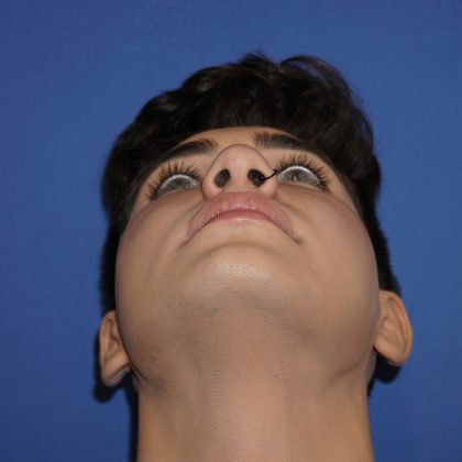 Rhinoplasty Before & After Patient #9989