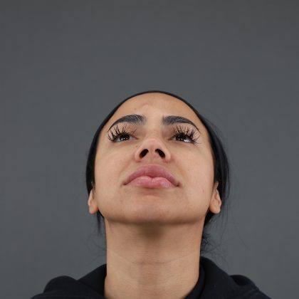 Rhinoplasty Before & After Patient #9990