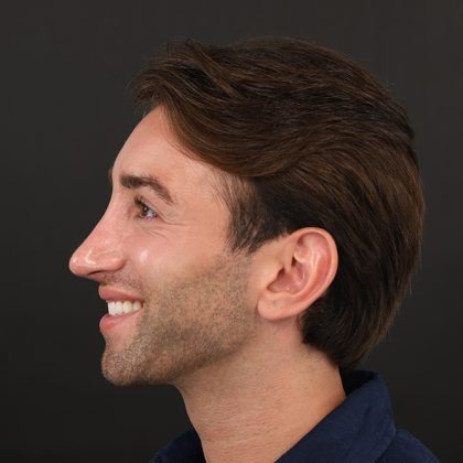 Rhinoplasty Before & After Patient #9785