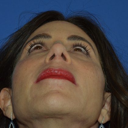 Regenelift™ Facelift Before & After Patient #9993