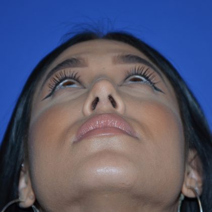 Rhinoplasty Before & After Patient #9995