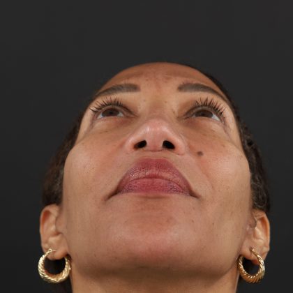 Regenelift™ Facelift Before & After Patient #9998