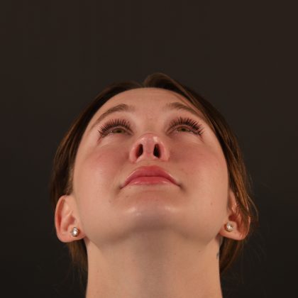 Rhinoplasty Before & After Patient #10000