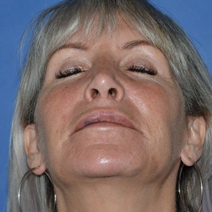 Regenelift™ Facelift Before & After Patient #9786