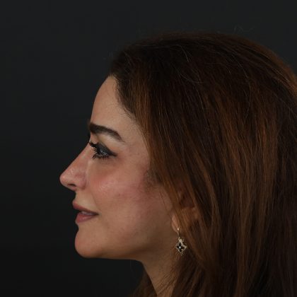 Regenelift™ Facelift Before & After Patient #9788