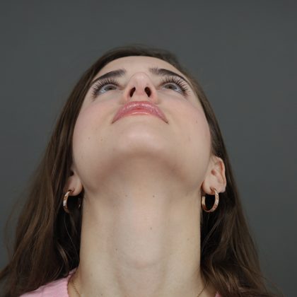 Rhinoplasty Before & After Patient #9790