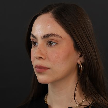 Rhinoplasty Before & After Patient #9783
