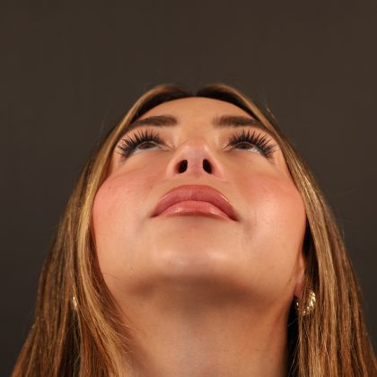 Rhinoplasty Before & After Patient #9987