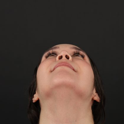 Rhinoplasty Before & After Patient #9988