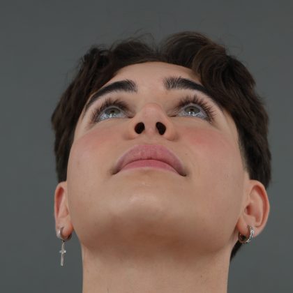 Rhinoplasty Before & After Patient #9989