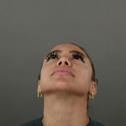 Rhinoplasty Before & After Patient #9990