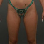 Buttock Augmentation Before & After Patient #9992
