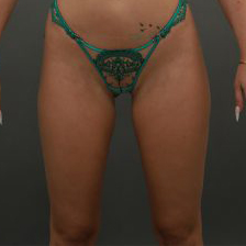 Buttock Augmentation Before & After Patient #9992