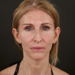 Regenelift&trade; Facelift Before & After Patient #10620