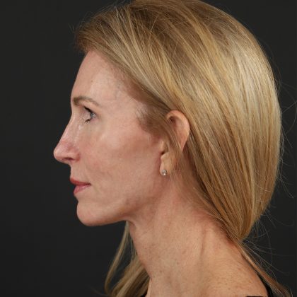 Regenelift™ Facelift Before & After Patient #10620