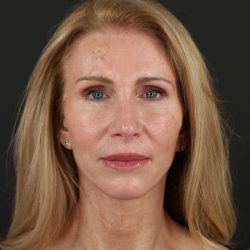 Regenelift™ Facelift Before & After Patient #10620