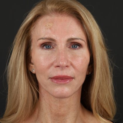 Regenelift&trade; Facelift Before & After Patient #10620