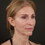 Regenelift&trade; Facelift Before & After Patient #10620