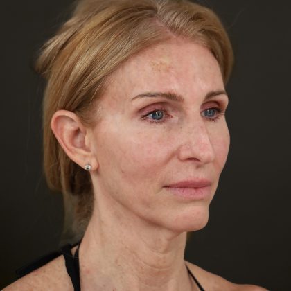 Regenelift™ Facelift Before & After Patient #10620