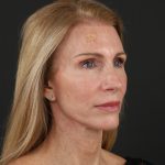 Regenelift&trade; Facelift Before & After Patient #10620