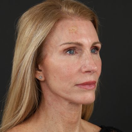 Regenelift™ Facelift Before & After Patient #10620