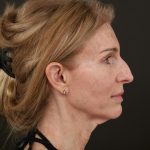 Regenelift&trade; Facelift Before & After Patient #10620