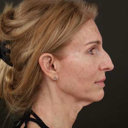 Regenelift™ Facelift Before & After Patient #10620