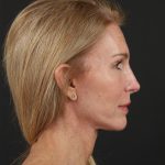 Regenelift&trade; Facelift Before & After Patient #10620
