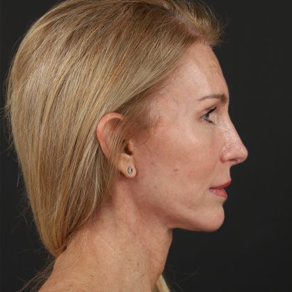 Regenelift™ Facelift Before & After Patient #10620