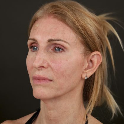Regenelift™ Facelift Before & After Patient #10620