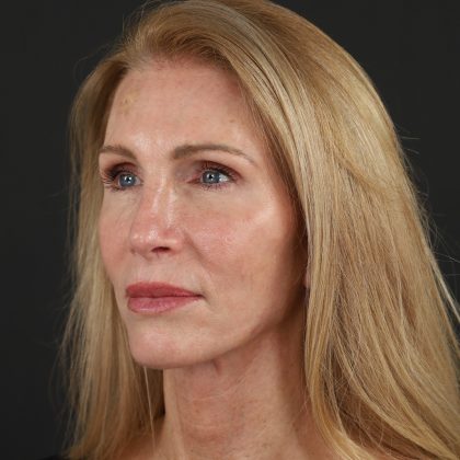 Regenelift™ Facelift Before & After Patient #10620