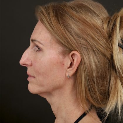 Regenelift™ Facelift Before & After Patient #10620