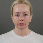 Facelift Before & After Patient #10640