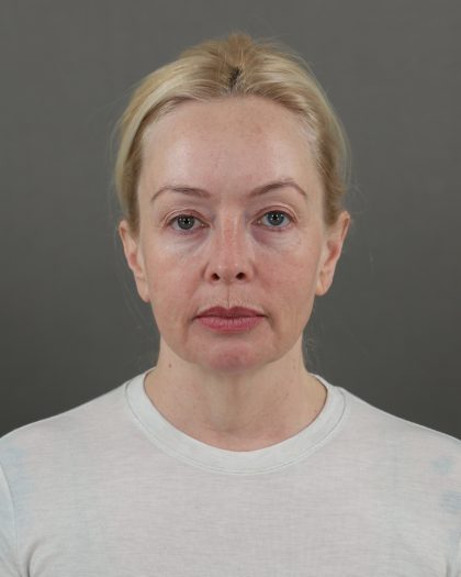 Facelift Before & After Patient #10640
