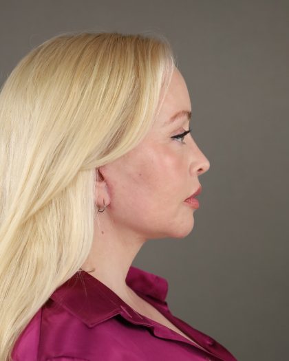 Facelift Before & After Patient #10640