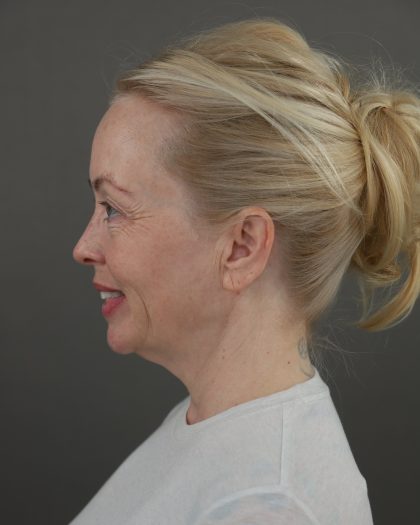 Facelift Before & After Patient #10640