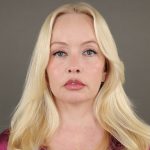 Facelift Before & After Patient #10640